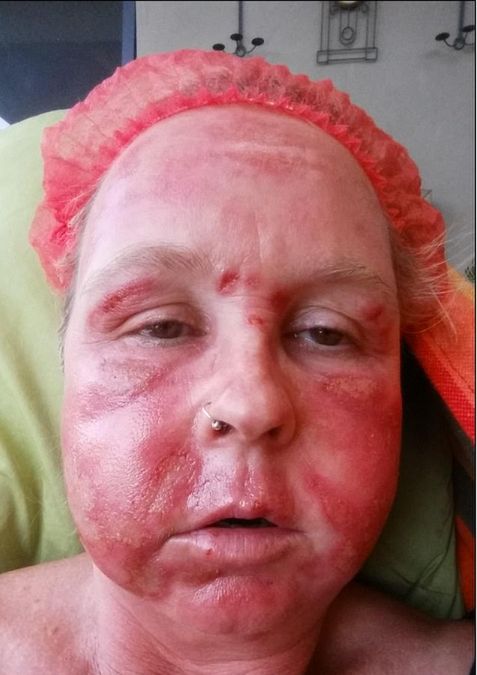 Kobieta została dotkliwie poparzona laserem 