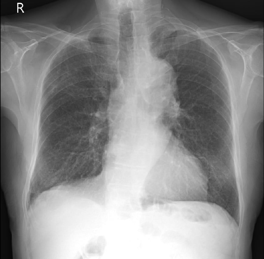 Obraz płuc przed wystąpieniem duszności