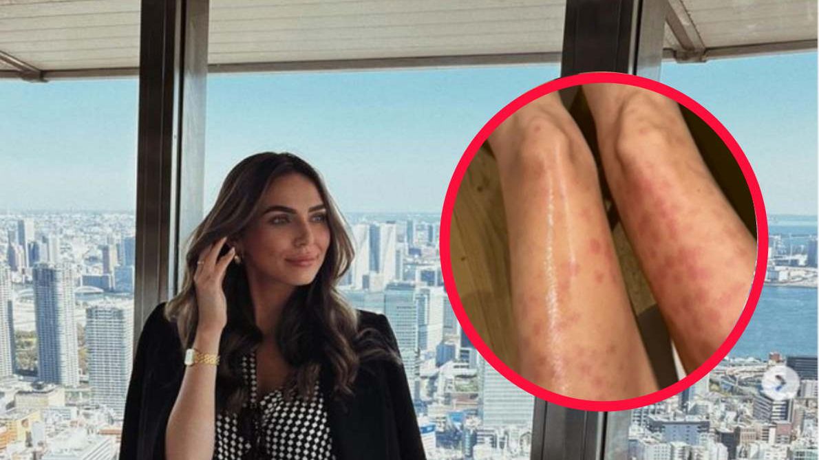 Chciała pozbyć się włosków z nóg. Teraz leczy poparzenia