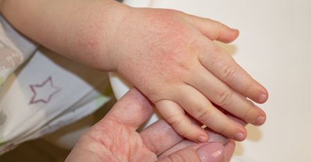 Marsz alergiczny – czym jest, przyczyny, objawy i leczenie