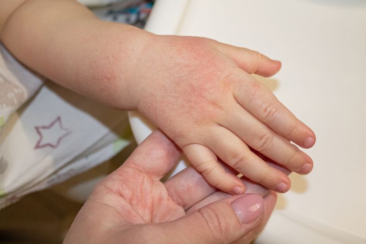 Marsz alergiczny rozpoczyna się we wczesnym okresie życia (okres niemowlęcy)