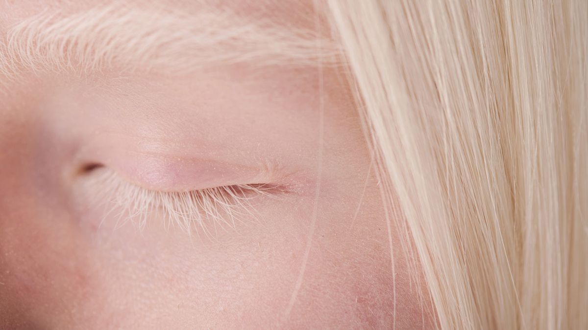 Zespół Chediaka i Higashiego cechuje się częściowym albinizmem