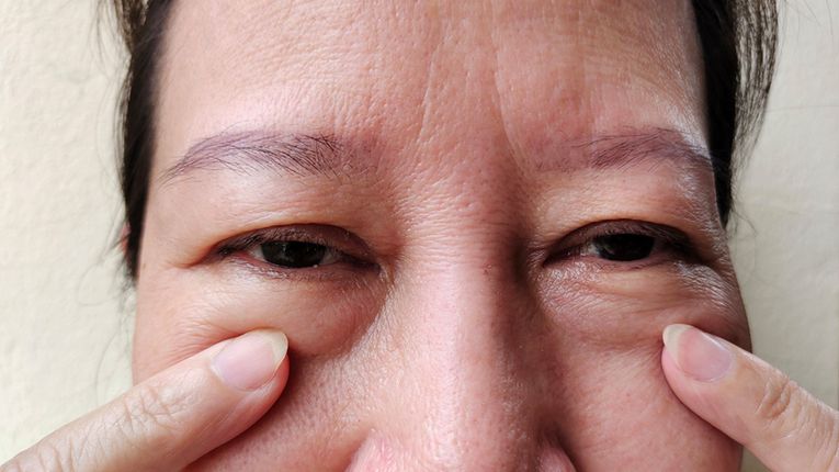 Worki pod oczami mogą być skutkiem choroby