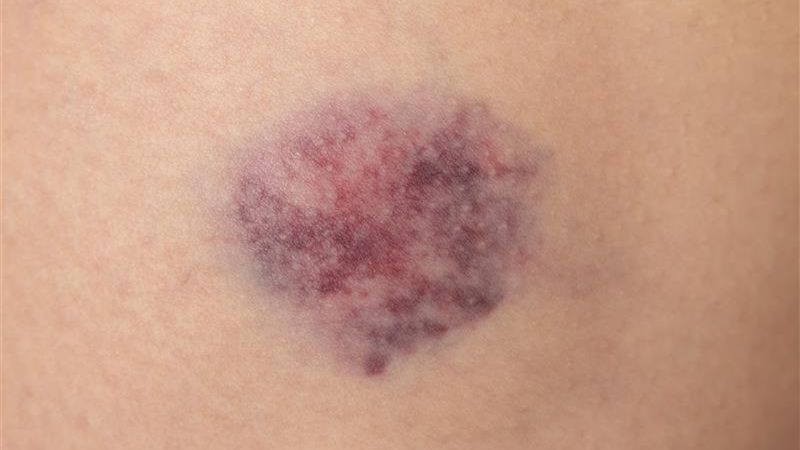 Czy siniaki mogą być objawem choroby?