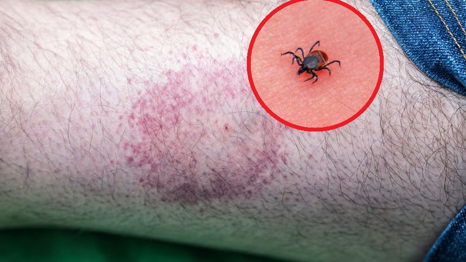 Niebezpieczny wirus przenoszony przez kleszcze