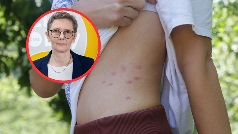 Prof. Zajkowska ostrzega. Półpasiec może dotknąć każdego, kto chorował na ospę