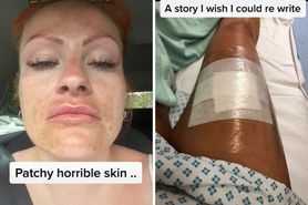 Była fanką solarium. Dziś przestrzega przed tym i publikuje szokujące zdjęcia