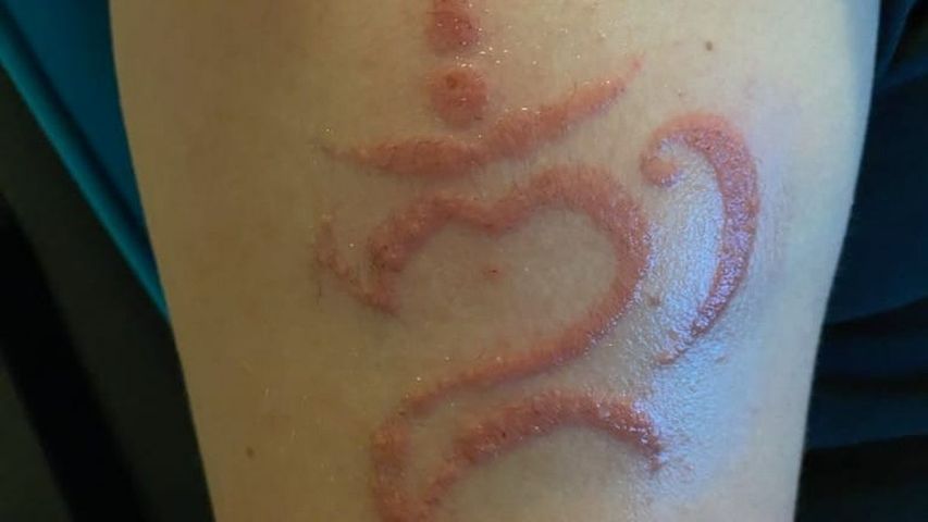 13-latek zrobił sobie tatuaż z henny na wakacjach. Została mu ogromna blizna