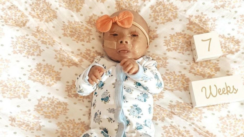 Dziewczynka urodziła się z rzadką chorobą genetyczną. Jej skórę pokrywają "łuski"