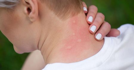 Ugryzienie meszki - charakterystyka, domowe sposoby, alergia, zatrucie hararą
