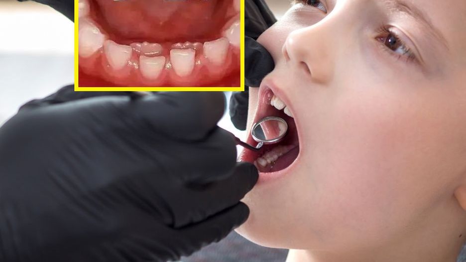 Lekarze zwracają uwagę na niepokojące zjawisko. "Podwójne zęby" są coraz częstsze