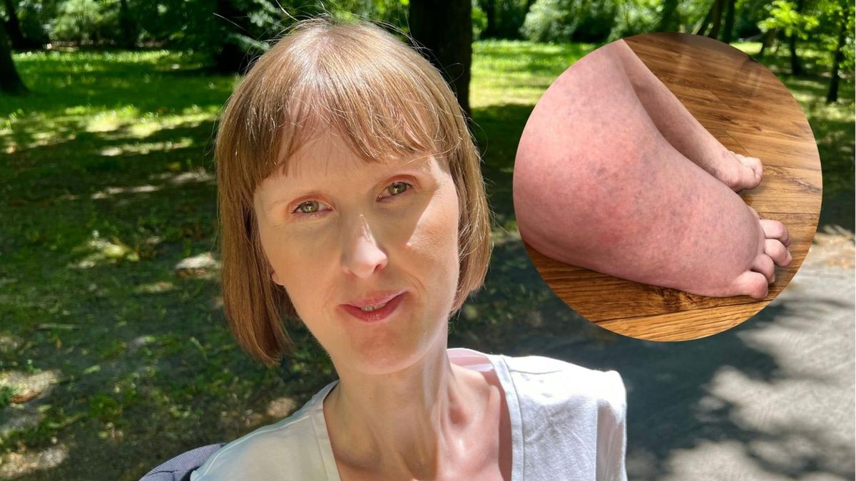 Joanna Gierz cierpi na postępujące kostniejące zapalenie mięśni. Jej ciało zamienia się w posąg