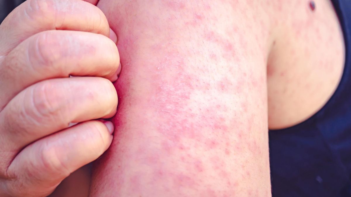 Będzie epidemia? Wróciła groźna choroba zakaźna