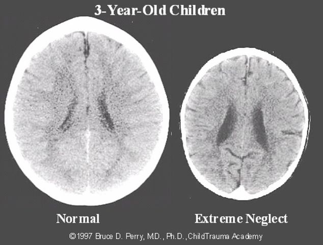 Brak dotyku upośledza rozwój mózgu dziecka.