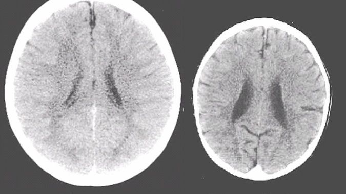 Brak dotyku upośledza rozwój mózgu dziecka.