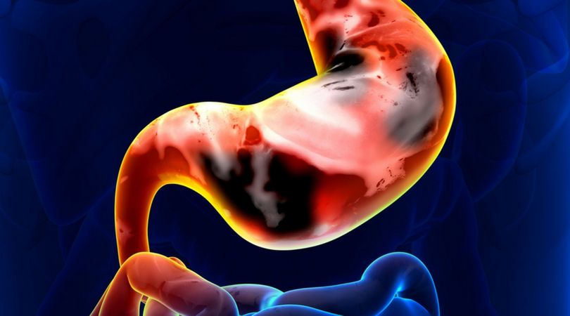 Nowotwory neuroendokrynne rozwijają się powoli i często niezauważalnie. Co należy o nich wiedzieć?