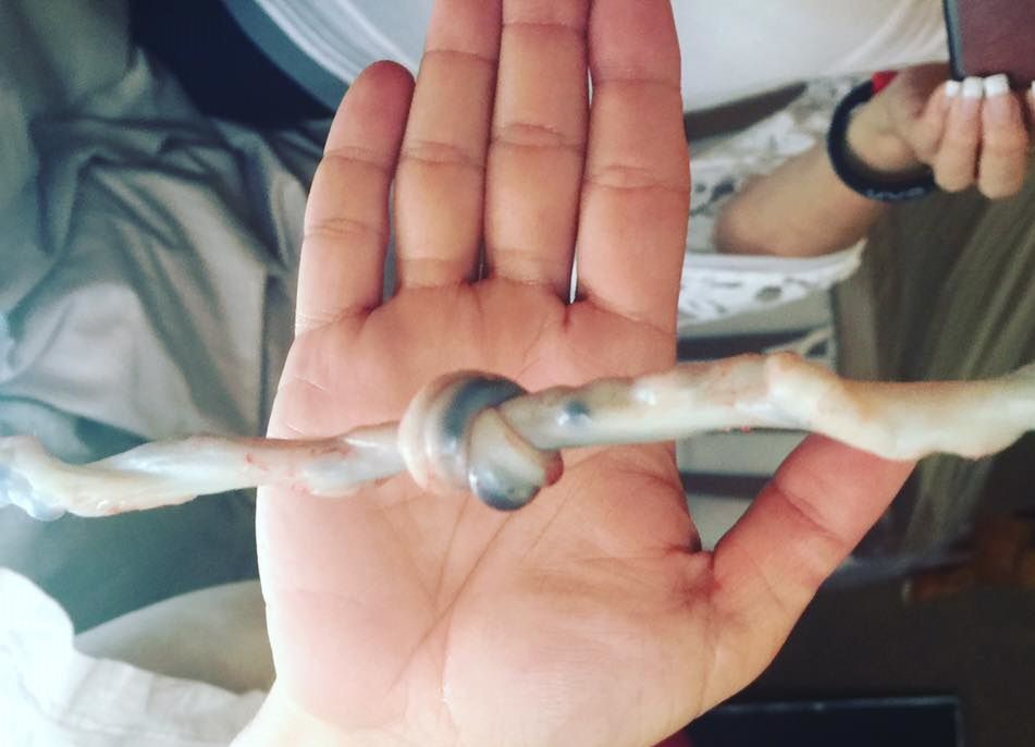 Węzeł na pępowinie