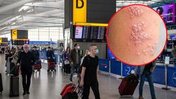 Przypadek rzadkiej choroby tropikalnej w Europie. Mężczyzna zaraził się małpią ospą