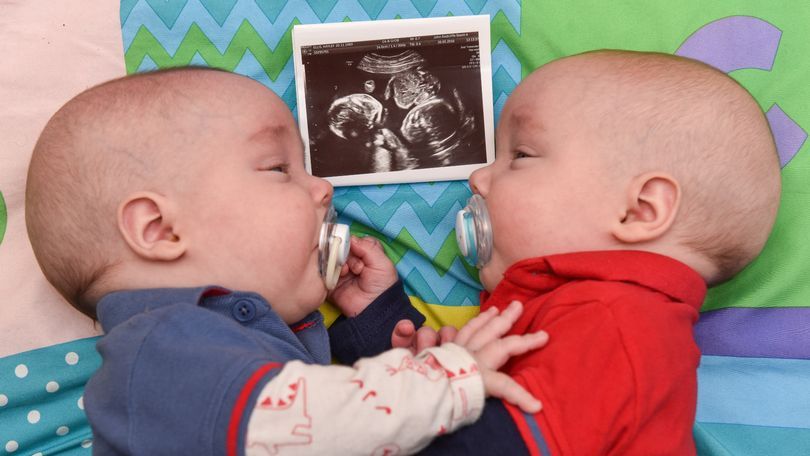 Bliźniaki trzymające się za rękę w łonie matki. Po porodzie dalej są nierozłączni
