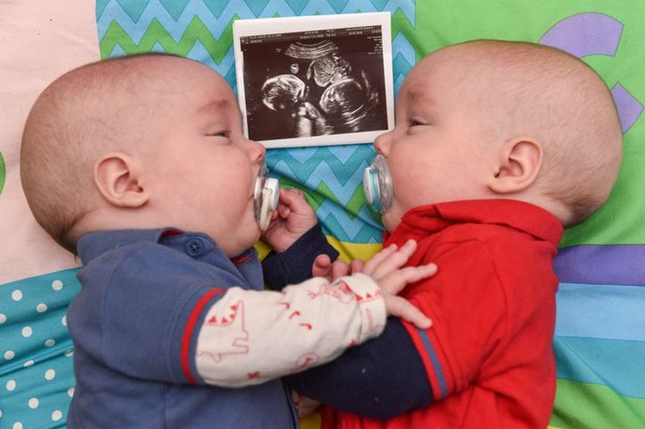 Bliźniaki trzymające się za rękę w łonie matki. Po porodzie dalej są nierozłączni