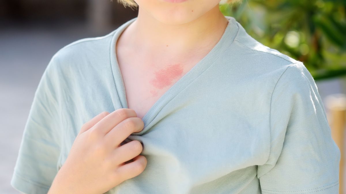 Malformacje naczyniowe to nienowotworowe zmiany wrodzone, które powstają wskutek zaburzeń rozwoju naczyń na etapie życia płodowego.