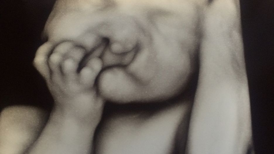 Odmówili aborcji synka z powodu deformacji. Tak chłopiec wygląda dzisiaj