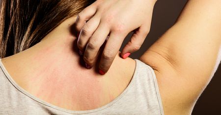 Alergiczne kontaktowe zapalenie skóry - charakterystyka, czynniki ryzyka