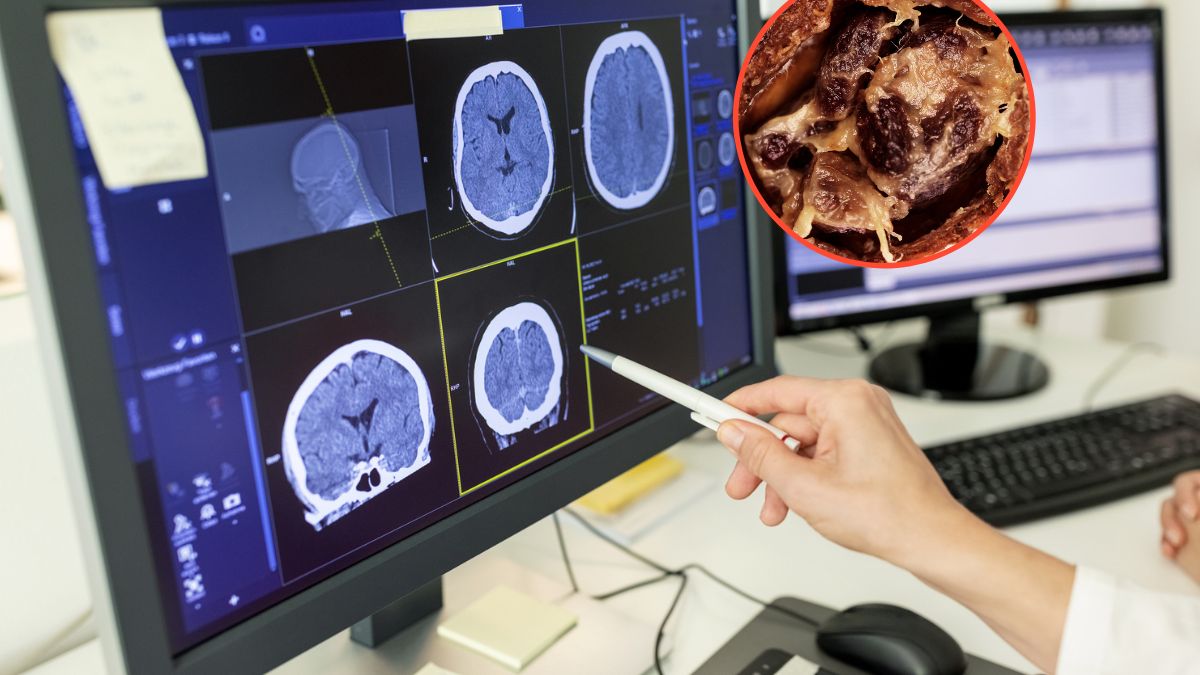 Neuroplastyczność po ibogainie. Spektakularne wyniki w leczeniu TBI