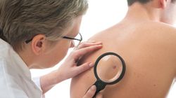 6 zaskakujących czynników, powodujących raka skóry