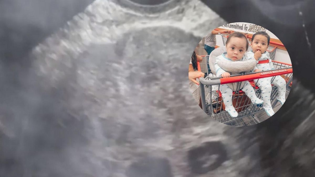 Jedno z bliźniąt ma syndrom DOwna