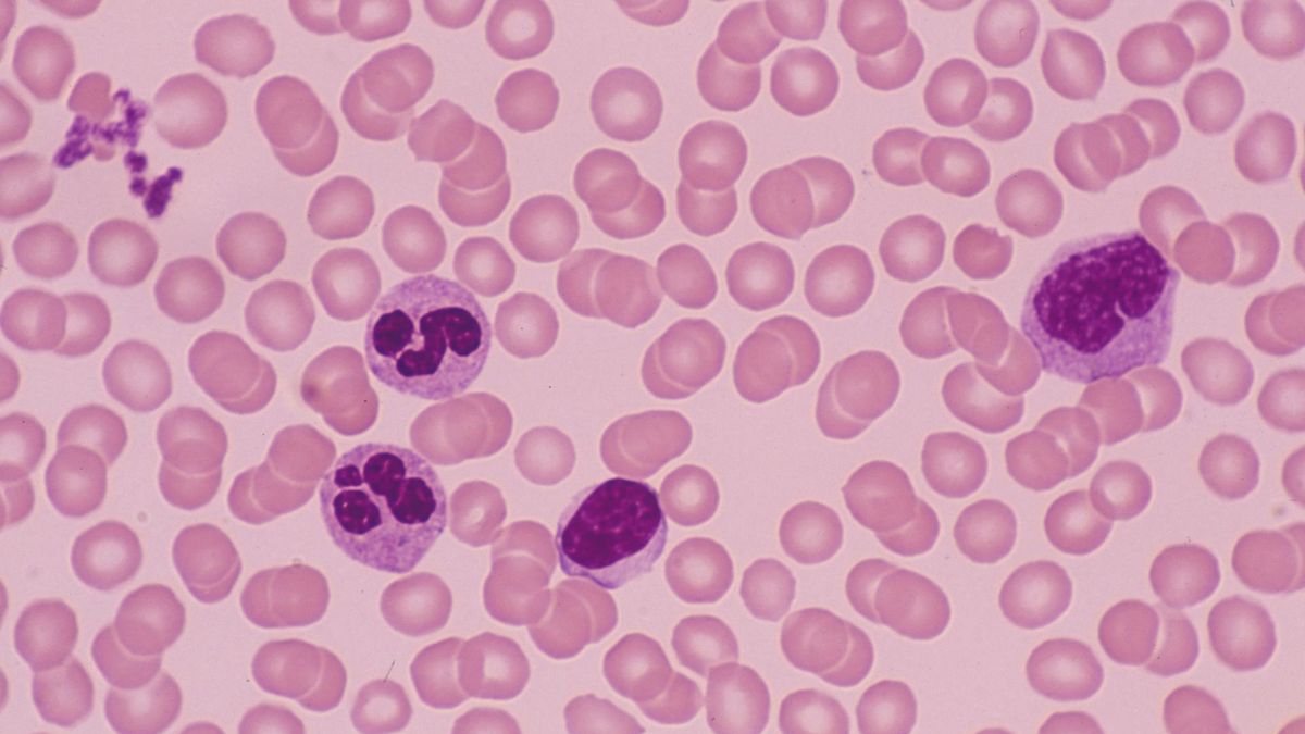 Limfocytoza to stan chorobowy, w którym stwierdza się podwyższony poziom limfocytów.