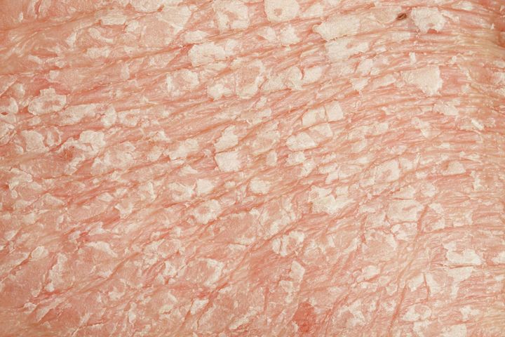 Łuszczyca to choroba skóry o przewlekłym przebiegu