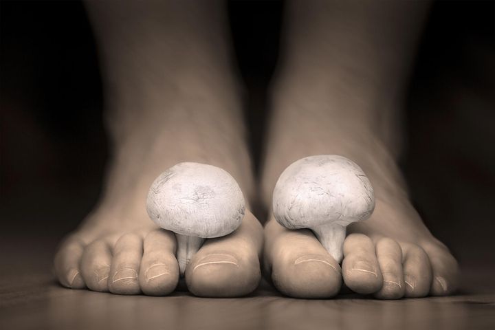 Grzybica stóp to jedna z częściej występujących odmian tej choroby