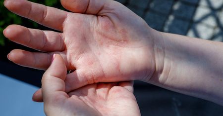 Choruje co piąty Polak. Objawy często pojawiają się na skórze