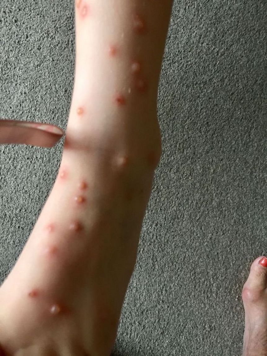 Ślady na nogach dziewczynki