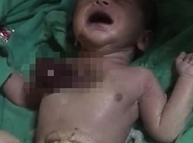 W północnych Indiach przyszło na świat dziecko z sercem na wierzchu. 