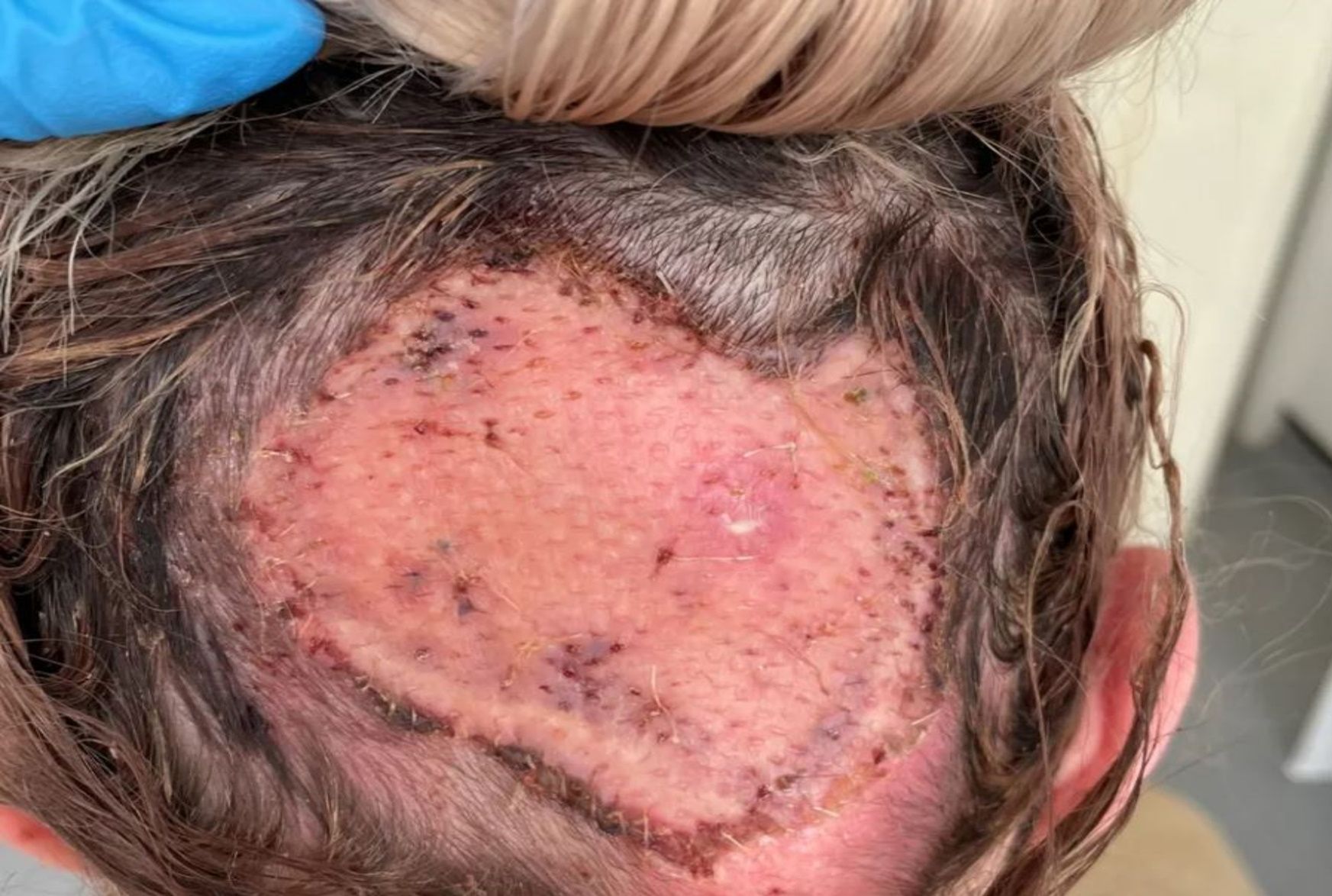 Ellie Swain musiała przejść przeszczep skóry głowy. 