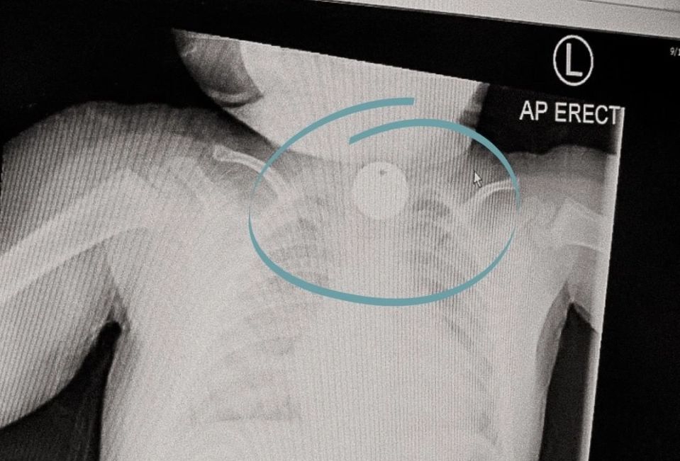 Dziecko połknęło żeton do wózka. Cudem przeżyło