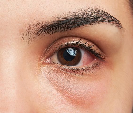 Czerwone oczy - zapalenie spojówek, alergia, zapalenie błony naczyniowej, zmęczenie