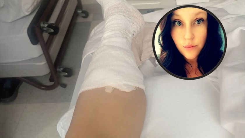 Wrastające paznokcie doprowadziły do amputacji