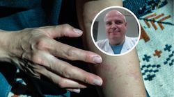 Jak rozpoznać niepokojące znamię? Lekarz wskazuje, czego nie wolno ignorować