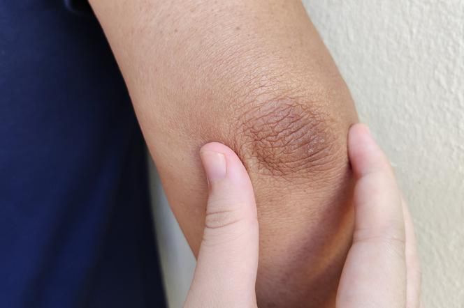 Przesuszona skóa wymaga odpowiedniej pielęgnacji