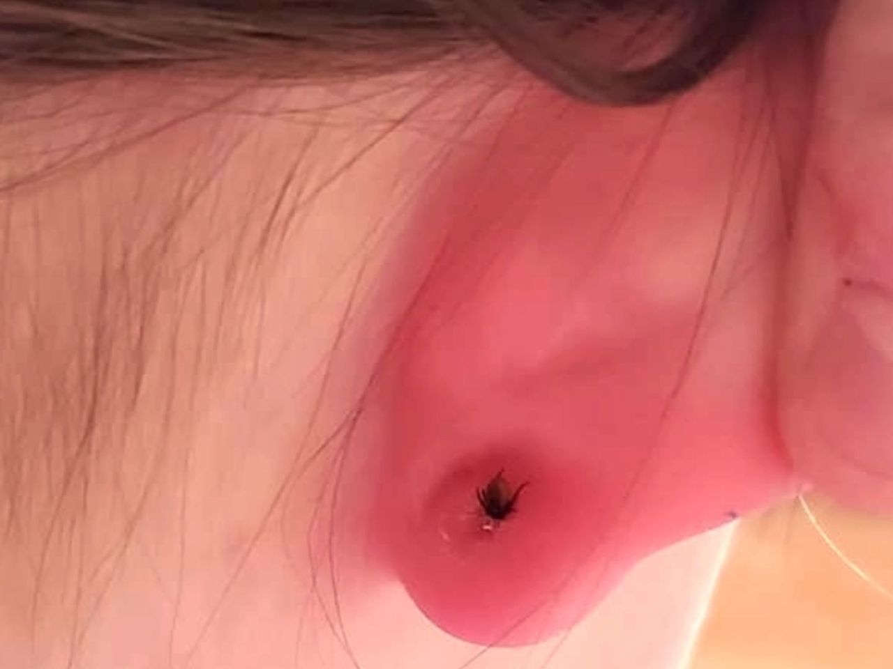 Kleszcze uwielbiają nietypowe miejsca. Lekarka pokazała zdjęcie dziecka