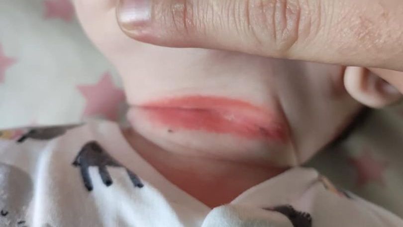 Śpioszki spowodowały bolesne rany na ciele niemowlaka