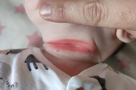 Śpioszki spowodowały bolesne rany na ciele niemowlaka