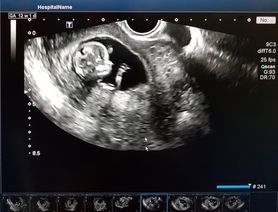 Noworodek miał wzdęty brzuszek. Okazało się, że jest "w ciąży"