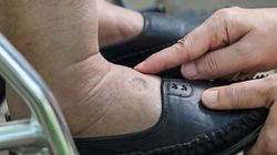 Puchnięcie nóg - objawy, przyczyny, domowe sposoby