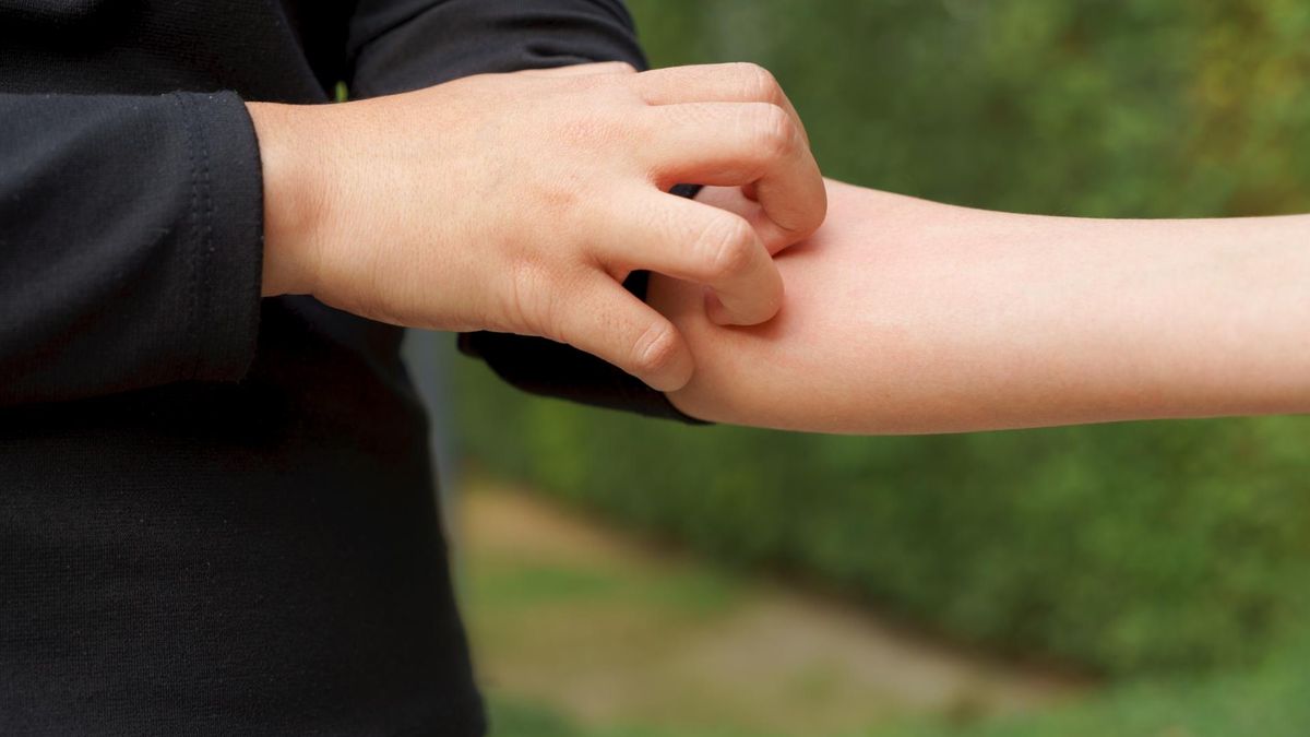 Ukąszenie komara boli i swędzi. Działać trzeba natychmiast