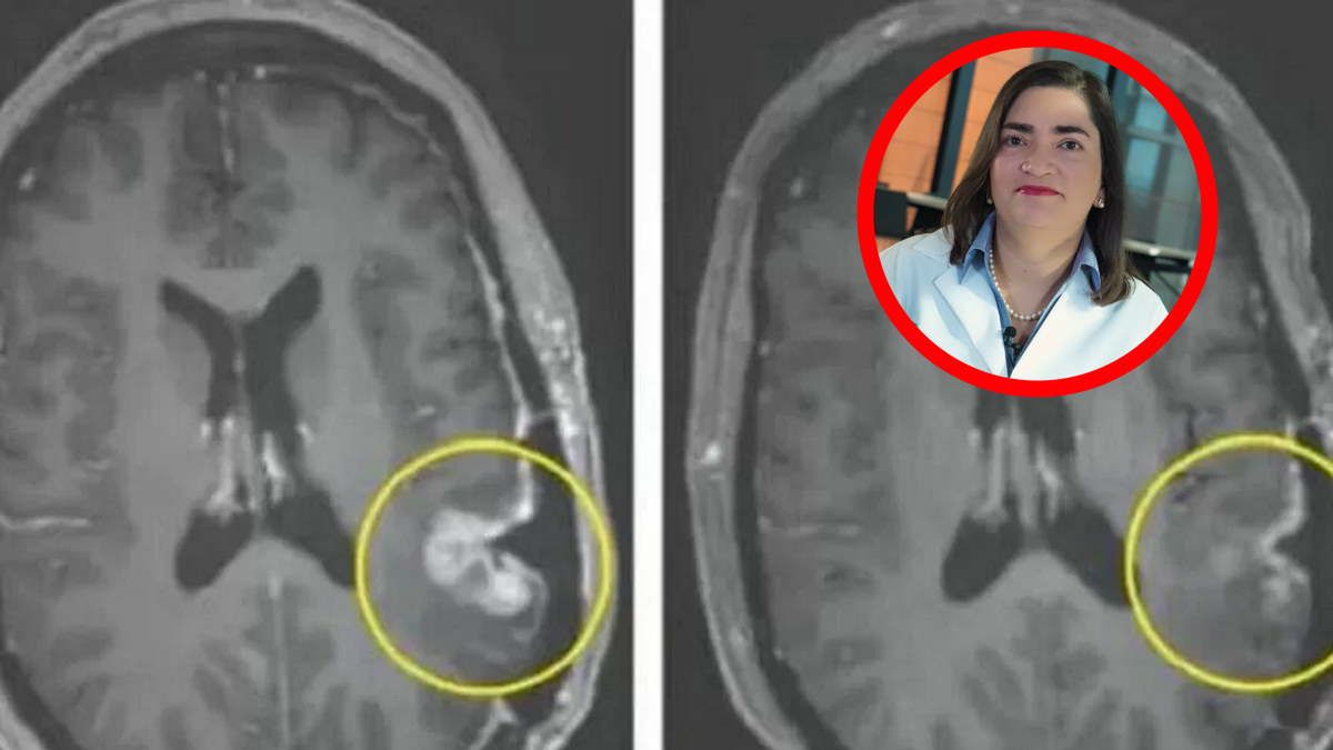 Przełom w leczeniu guza mózgu? Niezwykła skuteczność innowacyjnej terapii