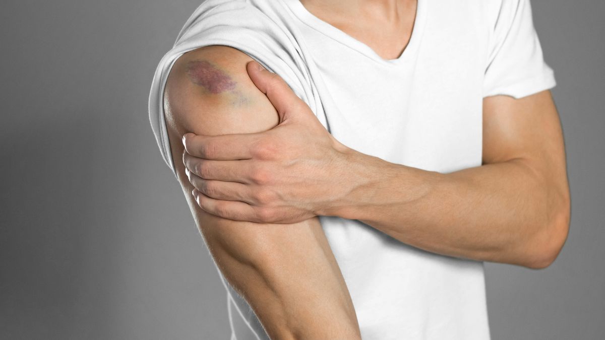 Siniaki najczęściej są efektem uderzenia lub nacisku.